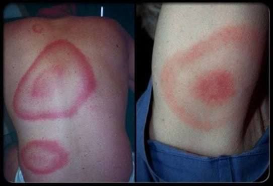 В Одесской области за неделю зафиксировали три подозрения на болезнь Лайма