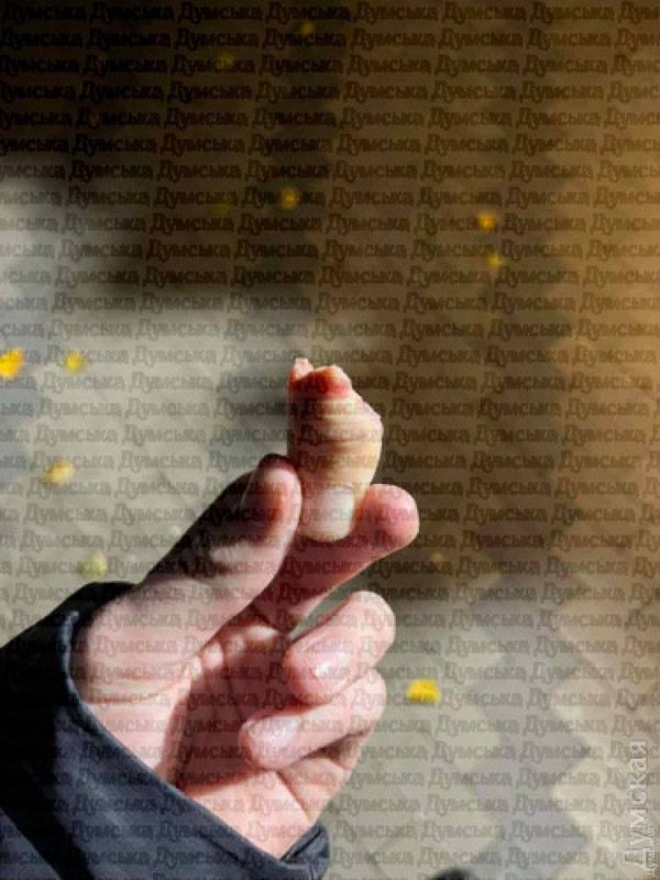 В Одессе 14-летний фигурист остался без пальца, врачи не хотели ему помогать